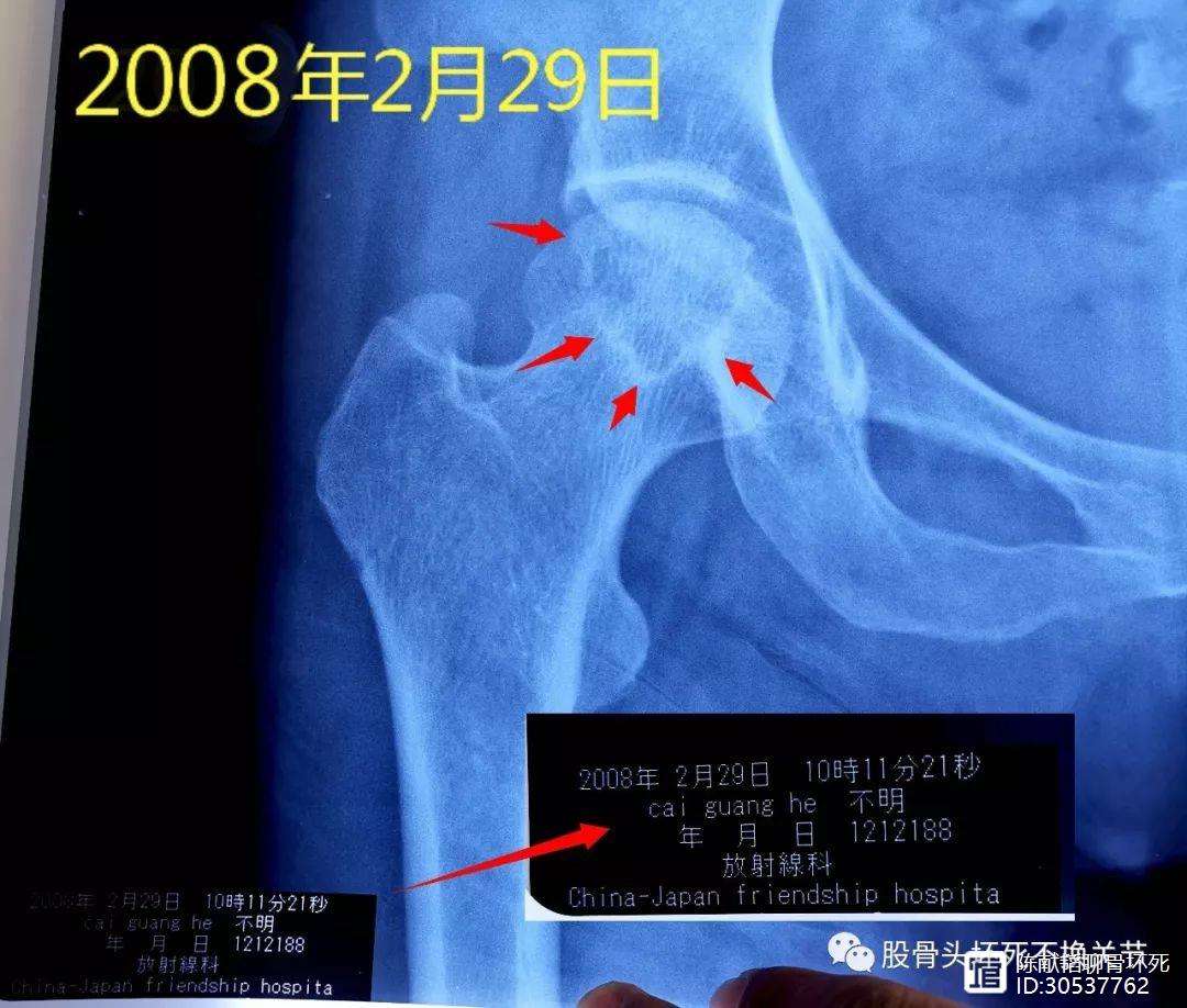 东方人工骨头医保报销多少(人工骨头医保报销多少比例)